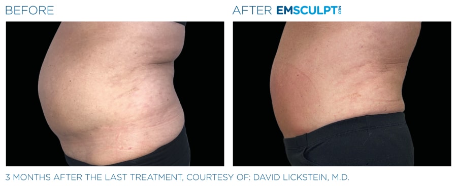 Emsculpt NEO Before and After image of a man's abdomen showing a reduced fat.