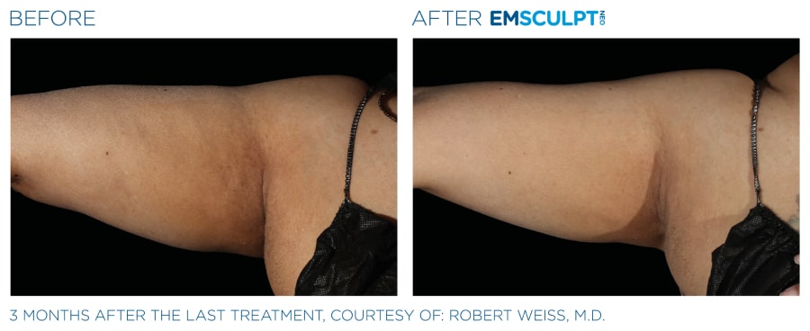 Emsculpt NEO Before and After image of a woman's arm showing a reduced fat.