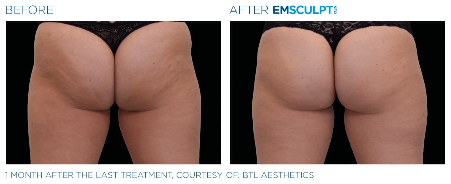 Emsculpt NEO Before and After image of a woman's buttocks showing a reduced fat.