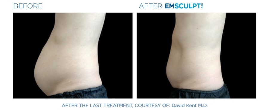 Emsculpt NEO Before and After image of a man's abdomen showing a reduced fat volume.